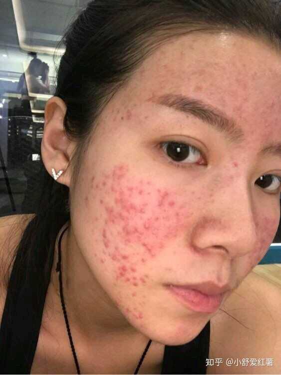如何有效去除臉上的痘印——全方位指南，全方位指南，如何有效去除臉上痘印的方法