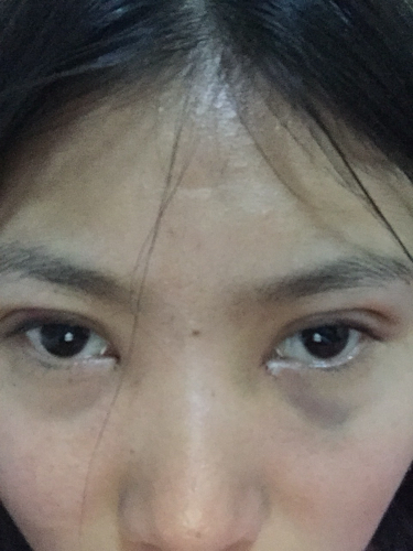 關(guān)于開眼角與割雙眼皮手術(shù)費(fèi)用解析，究竟需要多少錢？，開眼角與割雙眼皮手術(shù)費(fèi)用全解析，究竟要花多少錢？