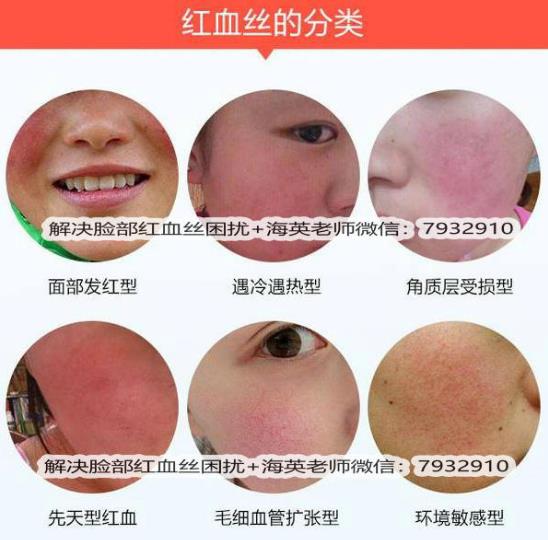 臉上出現(xiàn)紅血絲怎么治療，全面解析有效方法，臉上紅血絲全面解析與有效治療方法