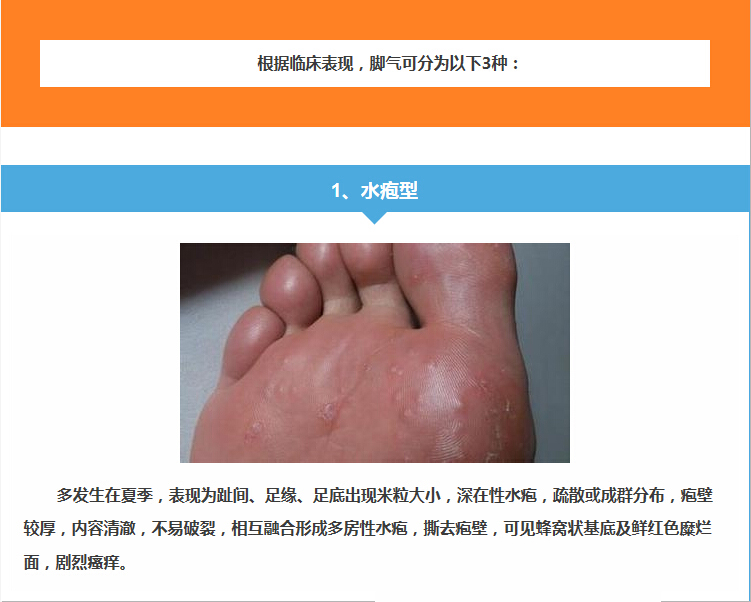 水泡型腳氣怎么治能除根——全面解析最佳治療方案，水泡型腳氣根治攻略，全面解析最佳治療方案