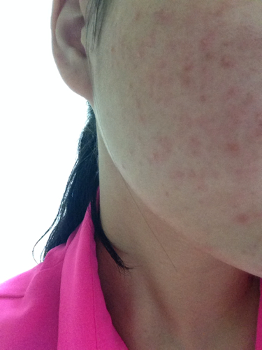 臉上突然長(zhǎng)了好多紅色的痘痘，原因、治療與預(yù)防，臉部紅色痘痘，成因、治療與預(yù)防措施