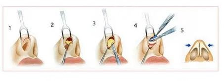 微調(diào)鼻子需要多少錢，全面解析費(fèi)用因素與注意事項(xiàng)，微調(diào)鼻子費(fèi)用全解析，費(fèi)用因素與注意事項(xiàng)，需要多少錢？
