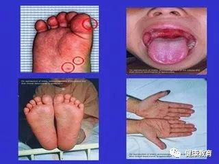 手足口病癥狀詳解，了解、預(yù)防與治療，手足口病癥狀詳解，了解、預(yù)防與治療措施