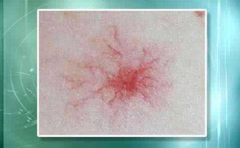 肝癌身上出現(xiàn)紅點(diǎn)圖片，癥狀解析與關(guān)注，肝癌身上紅點(diǎn)解析，癥狀、圖片及關(guān)注重點(diǎn)