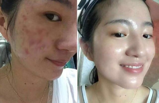 痘印多久會(huì)自己消失？全面解析痘印消失時(shí)間與影響因素，痘印消失時(shí)間全面解析，影響因素與消失時(shí)長探討