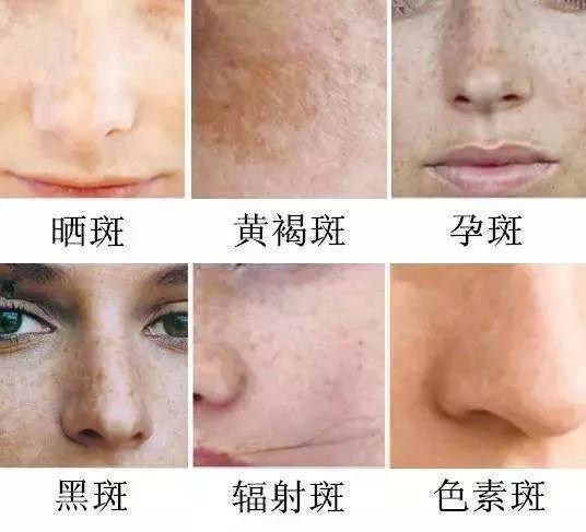 如何有效去除臉上斑點——全方位指南，全方位指南，如何有效去除臉上斑點