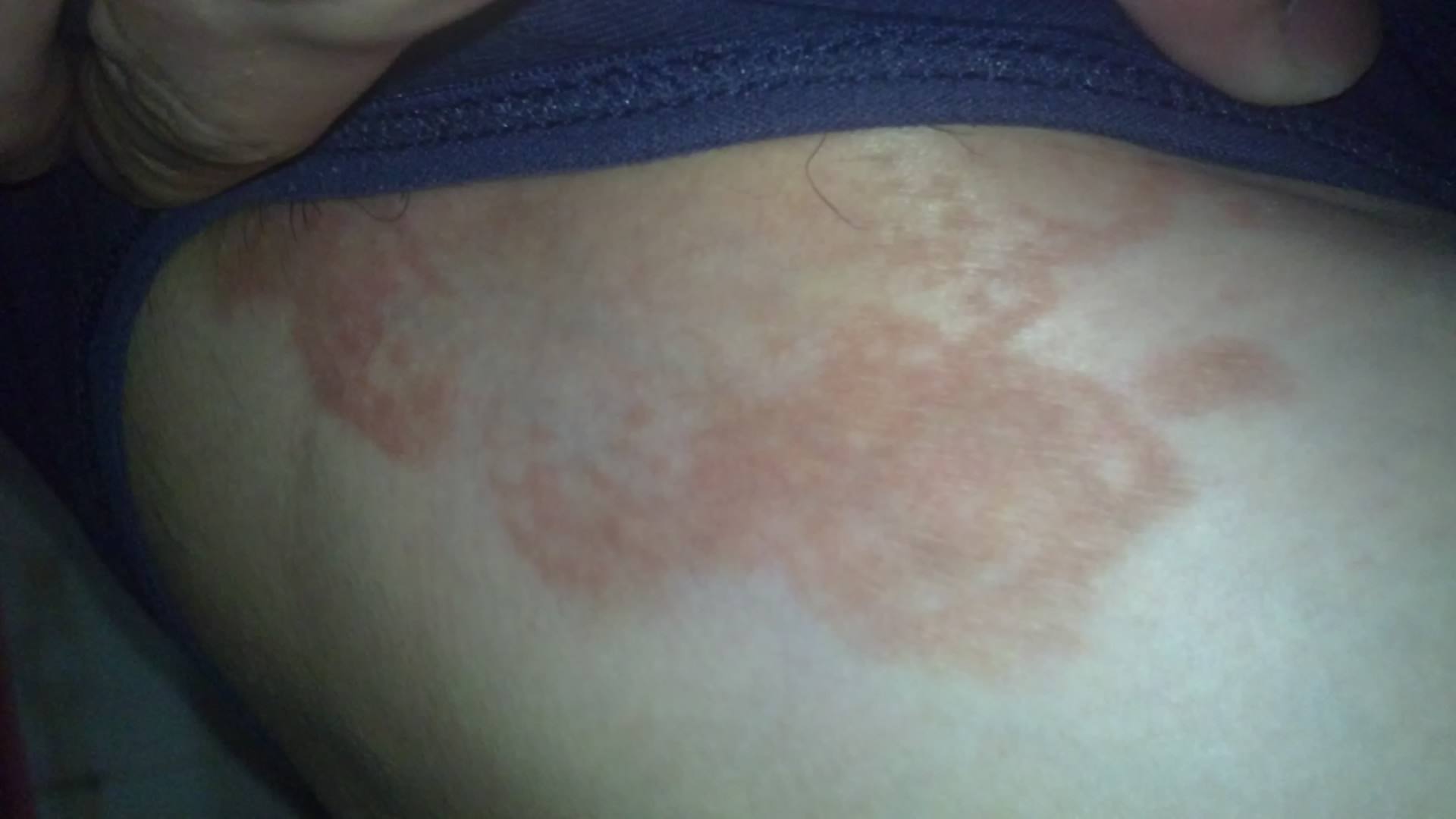 股癬最佳治療藥膏，了解并選擇最適合的藥膏，股癬最佳治療藥膏推薦，選擇最適合的藥膏治療股癬