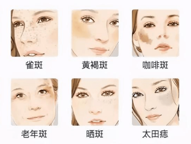 黃褐斑與曬斑的區(qū)別，深入了解兩種常見皮膚問題的差異，黃褐斑與曬斑的深入解析，兩種常見皮膚問題的差異探究