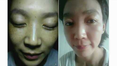 去掉黃褐斑的好方法，有效去除黃褐斑的方法