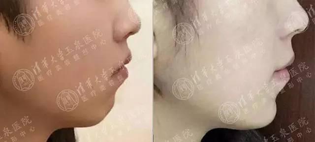 整容下頜骨大概需要多少錢——全面解析費用因素與選擇策略，整容下頜骨費用全面解析，費用因素與選擇策略指南