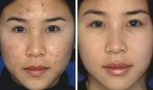 去痘痘的最快方法，針對(duì)青少年肌膚的有效解決方案（適合18歲以下人群），針對(duì)青少年肌膚的快速祛痘方法，適合18歲以下人群的有效解決方案