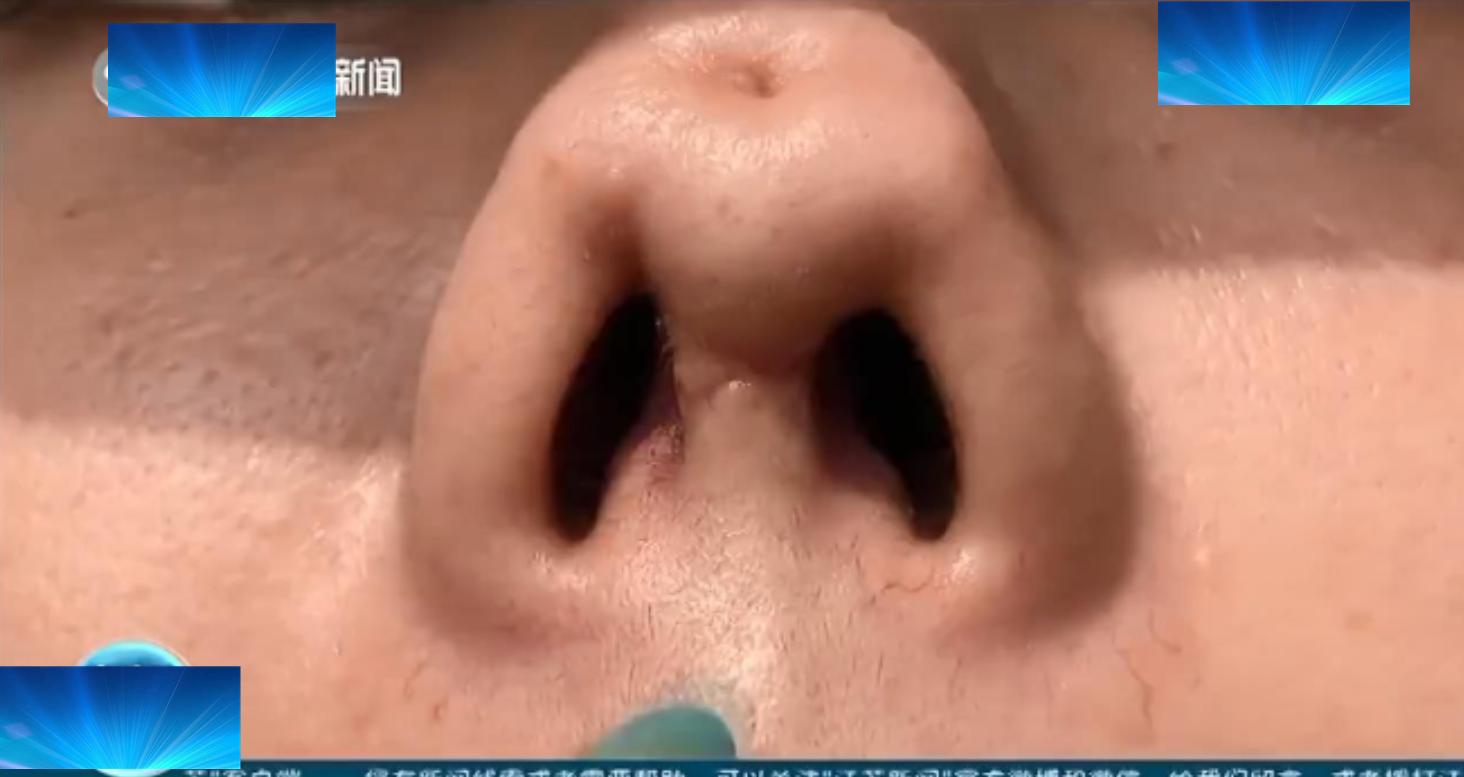 做隆鼻手術哪家比較好，深度解析與選擇指南，深度解析，如何選擇優(yōu)秀的隆鼻手術醫(yī)院與專家指南