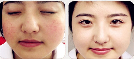 臉上紅血絲的治療方法，全面解析與應(yīng)對(duì)之道，全面解析與應(yīng)對(duì)之道，臉上紅血絲的治療方法