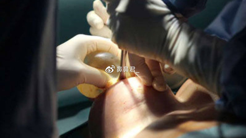 隆胸假體取出親身經(jīng)歷分享，我的手術(shù)經(jīng)歷與恢復(fù)過(guò)程，隆胸假體取出手術(shù)經(jīng)歷分享，我的恢復(fù)之旅