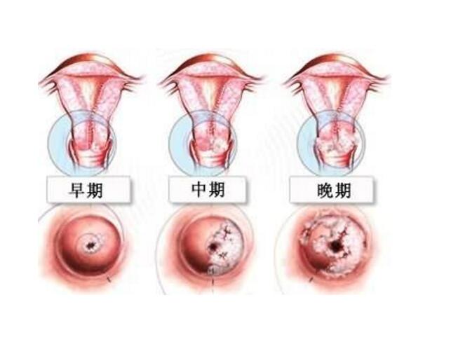 初期宮頸癌的征兆與應對之策，初期宮頸癌的征兆及應對策略
