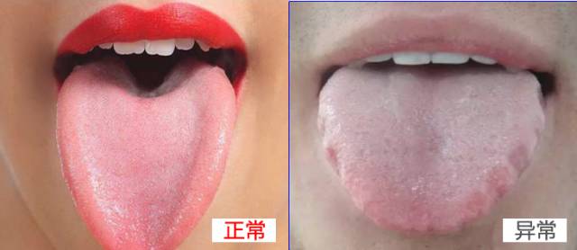 寒濕與濕熱舌頭圖片，中醫(yī)舌診解析，中醫(yī)舌診解析，寒濕與濕熱舌頭圖片對(duì)比及解析
