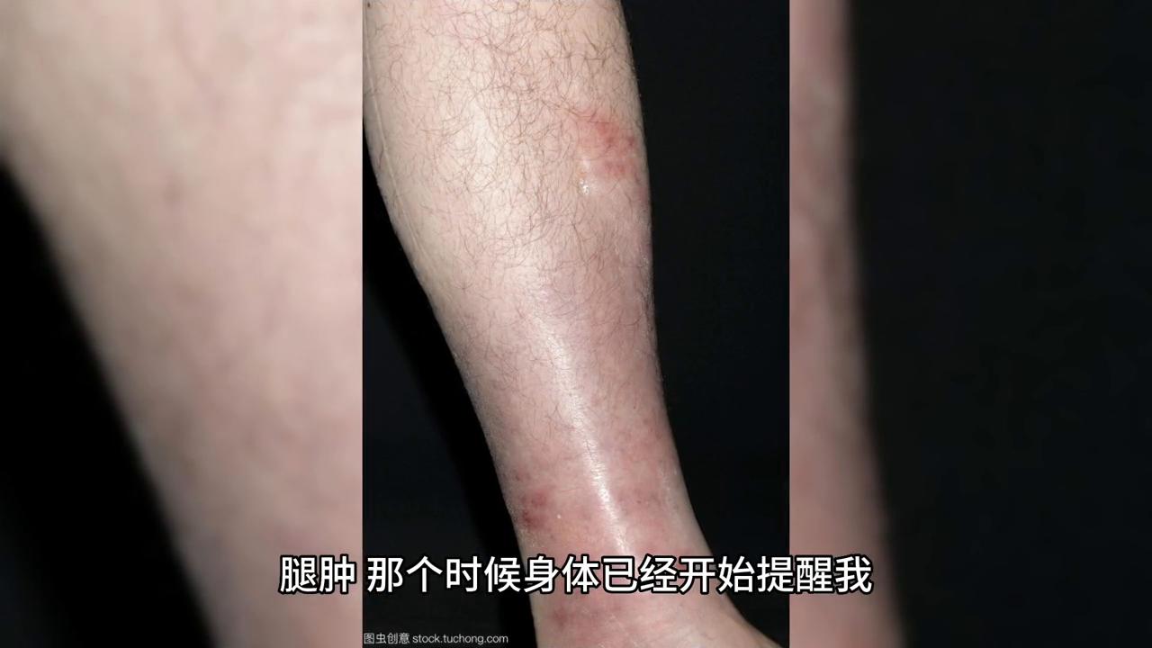 尿酸水平與尿毒癥，深入了解尿酸達(dá)到多少可能引發(fā)尿毒癥，尿酸水平與尿毒癥風(fēng)險(xiǎn)，尿酸超標(biāo)可能引發(fā)尿毒癥深度解析