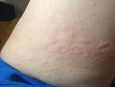 蕁麻疹患者飲食指南，哪些食物不宜食用？，蕁麻疹患者飲食禁忌指南，哪些食物不宜食用？