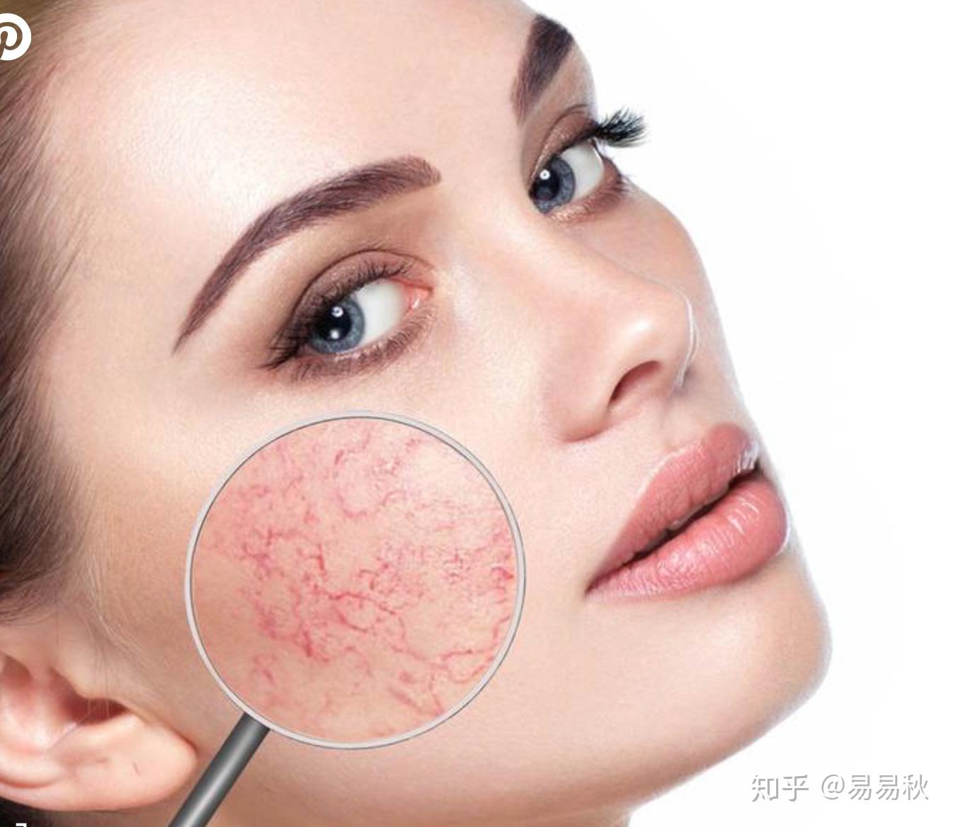 紅血絲的最佳改善方法，紅血絲的最佳改善方法總結(jié)與分享