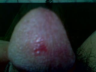 紅霉素軟膏涂龜頭后果分析，紅霉素軟膏涂龜頭的后果解析