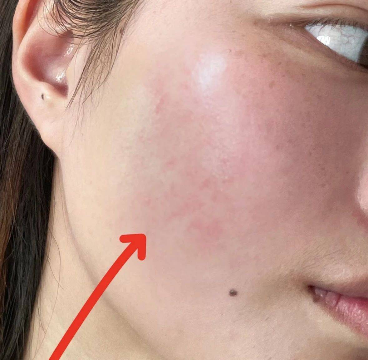 如何有效去除紅血絲，全方位解析與實(shí)用建議，全方位解析紅血絲去除方法，實(shí)用建議與有效治療策略