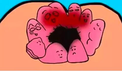 屁眼上面長了個小肉球，原因、診斷與治療方法，屁眼上長肉球，原因、診斷與治療方法全解析