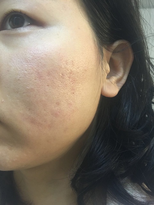 嚴(yán)重痤瘡治療最徹底的方法，全面攻略與最佳實(shí)踐，全面攻略揭秘，最徹底治療嚴(yán)重痤瘡的最佳實(shí)踐與最佳方法