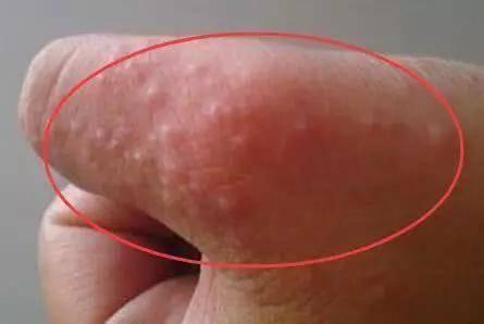 生殖上長小水泡的原因，深度解析與應(yīng)對建議，生殖部位小水泡成因深度解析及應(yīng)對建議