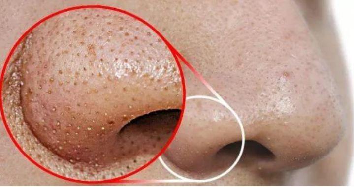 孩子身上起螨蟲(chóng)疙瘩圖片，了解、預(yù)防與治療，孩子身上的螨蟲(chóng)疙瘩，圖片、預(yù)防與治療全攻略