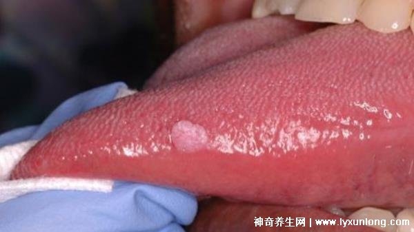 關(guān)于HPV感染舌頭初期的圖片及其相關(guān)解析，HPV感染舌頭初期癥狀圖片與解析