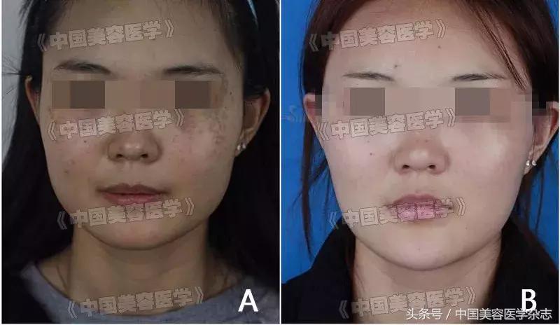 皮秒激光美容，做一次能維持多久？，皮秒激光美容，一次治療，持久維持的美容效果探討