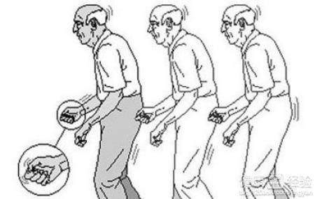 帕金森病的癥狀，深入了解與應(yīng)對(duì)，帕金森病癥狀詳解及應(yīng)對(duì)策略