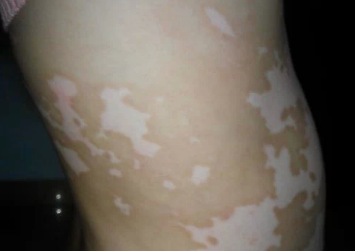 白顛瘋病初期照片癥狀圖片，了解白癜風(fēng)早期表現(xiàn)與防治，白癜風(fēng)初期癥狀圖片解析，了解白癜風(fēng)早期表現(xiàn)與防治攻略