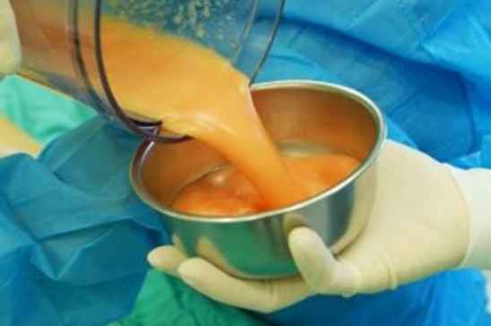 雙下巴抽脂手術費用詳解，價格因素與預算參考，雙下巴抽脂手術費用解析，預算參考與價格因素探討