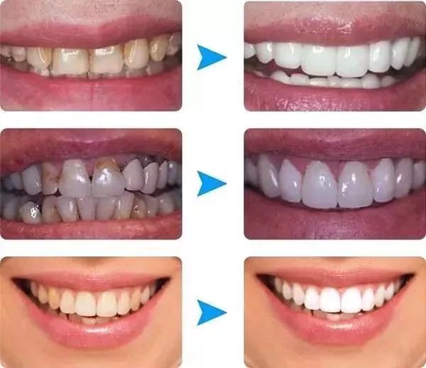 牙齒洗白要多少錢？全面解析牙齒美白費(fèi)用因素，牙齒美白費(fèi)用全解析，牙齒洗白需要多少錢？