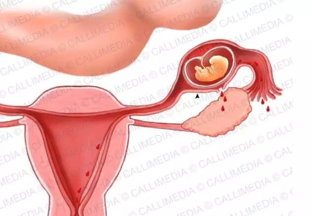 宮外孕20天最明顯的征兆，宮外孕20天的明顯征兆，早期識別與應(yīng)對的關(guān)鍵時刻