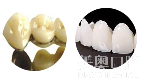 烤瓷牙和全瓷牙的利與弊，深度解析，深度解析，烤瓷牙與全瓷牙的優(yōu)缺點對比