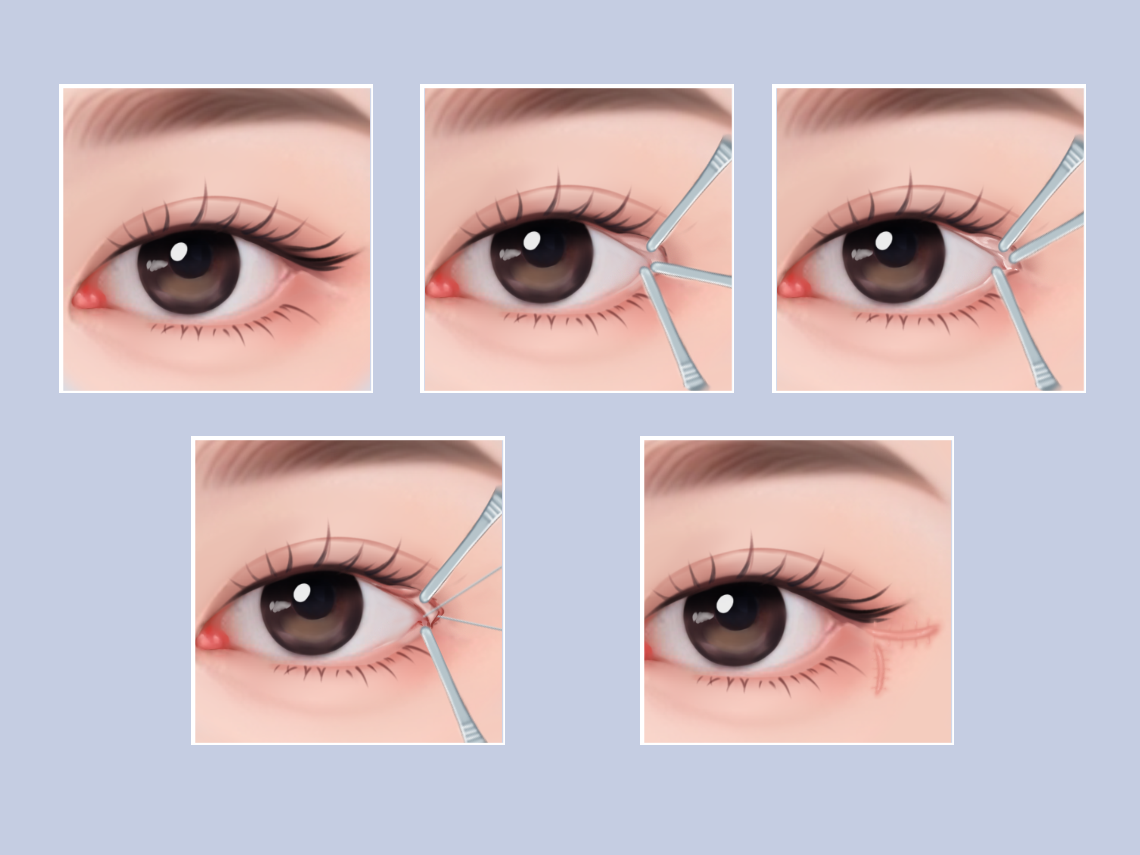 如何讓眼睛變大——全方位指南，全方位指南，讓眼睛變大的秘訣與方法