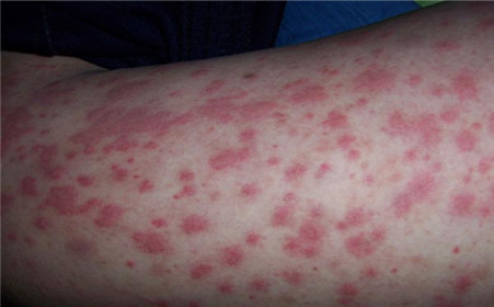 過(guò)敏性紫癜能自愈嗎？解析疾病真相與應(yīng)對(duì)之策，過(guò)敏性紫癜解析，能否自愈？真相與應(yīng)對(duì)策略探討