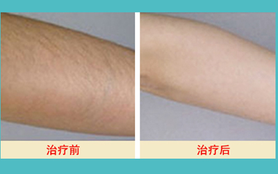 激光脫毛的價(jià)格解析，多少錢才能擁有絲滑肌膚？，激光脫毛價(jià)格詳解，多少錢能擁有絲滑肌膚？