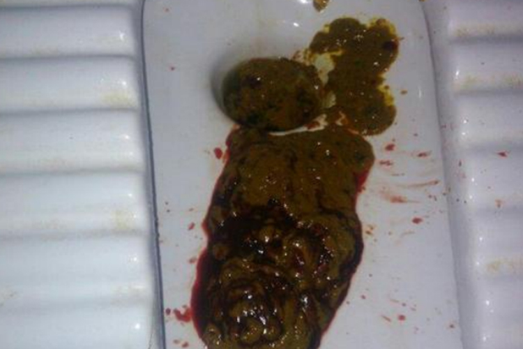 拉屎拉出鮮紅的血不痛，原因分析及應(yīng)對(duì)措施，無痛性鮮紅便血原因解析與應(yīng)對(duì)方案