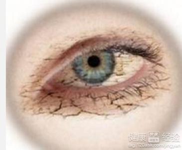 干眼癥怎樣能徹底治愈，全面理解與有效治療策略，全面理解與有效治療策略，干眼癥的根治之路